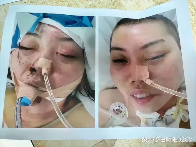 2022年澳门开奖结果和00后女孩自学插胃管与00后女孩自学插胃管视频